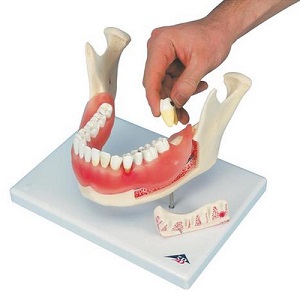 DENTAL DISEASE, MAGNIFIED 2 TIMES, 21 PARTS