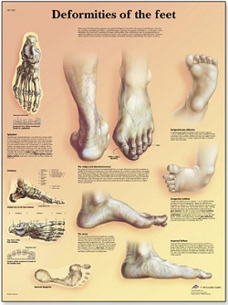 FOOT DEFORMITIES