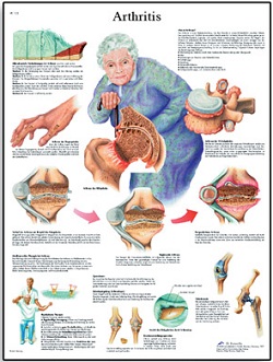 ANATOMICAL CHART - ARTHRITIS LAMINATED