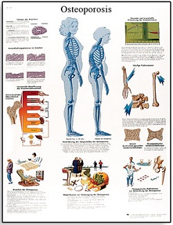 ANATOMICAL CHART - OSTEOPOROSIS LAMINATED