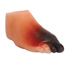 SEVERE DIABETIC FOOT MODEL